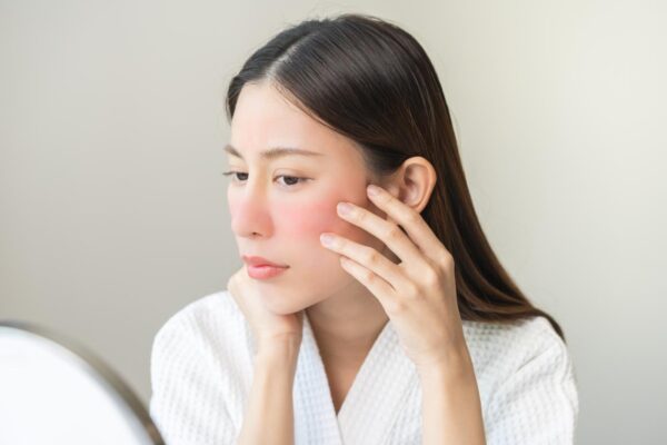 ผู้หญิงหน้าลอกเป็นขุย แสบแดง